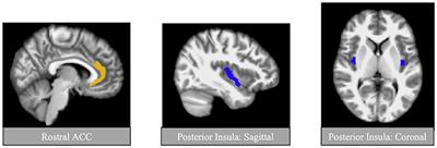 Preliminary Evidence for the Impact of Combat Experiences on Gray Matter Volume of the Posterior Insula